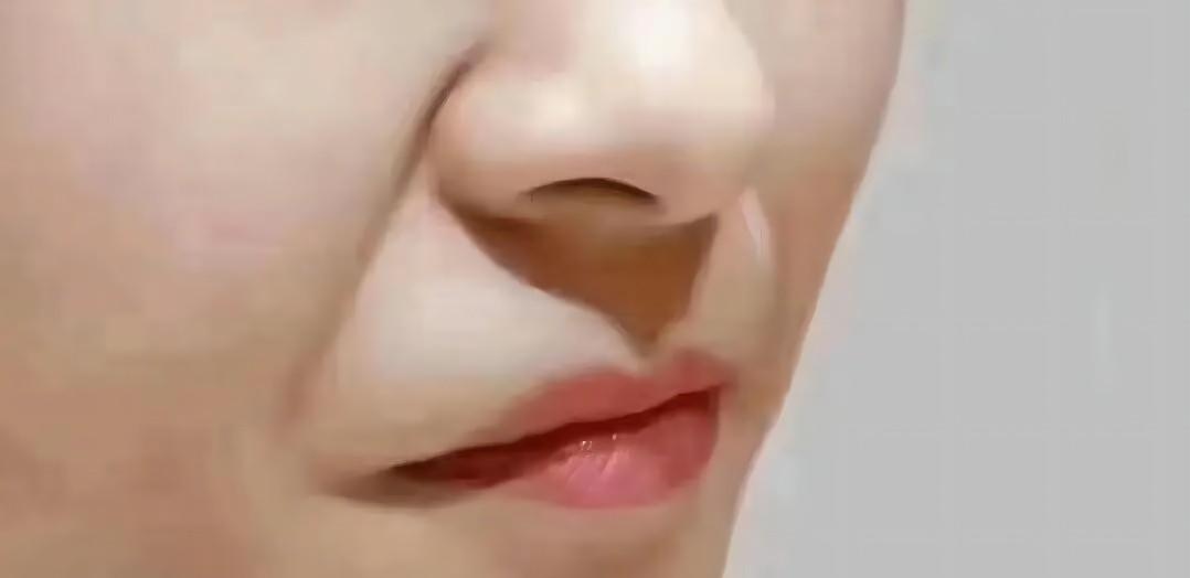 很深的法令纹怎么消除,已经有很深的法令纹怎么消除