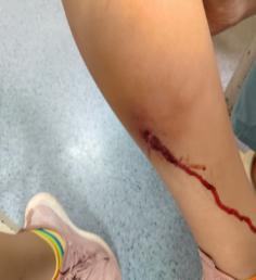 小孩皮肤有个红疙瘩里边有点硬块,小朋友皮肤上长疙瘩有白色脓包