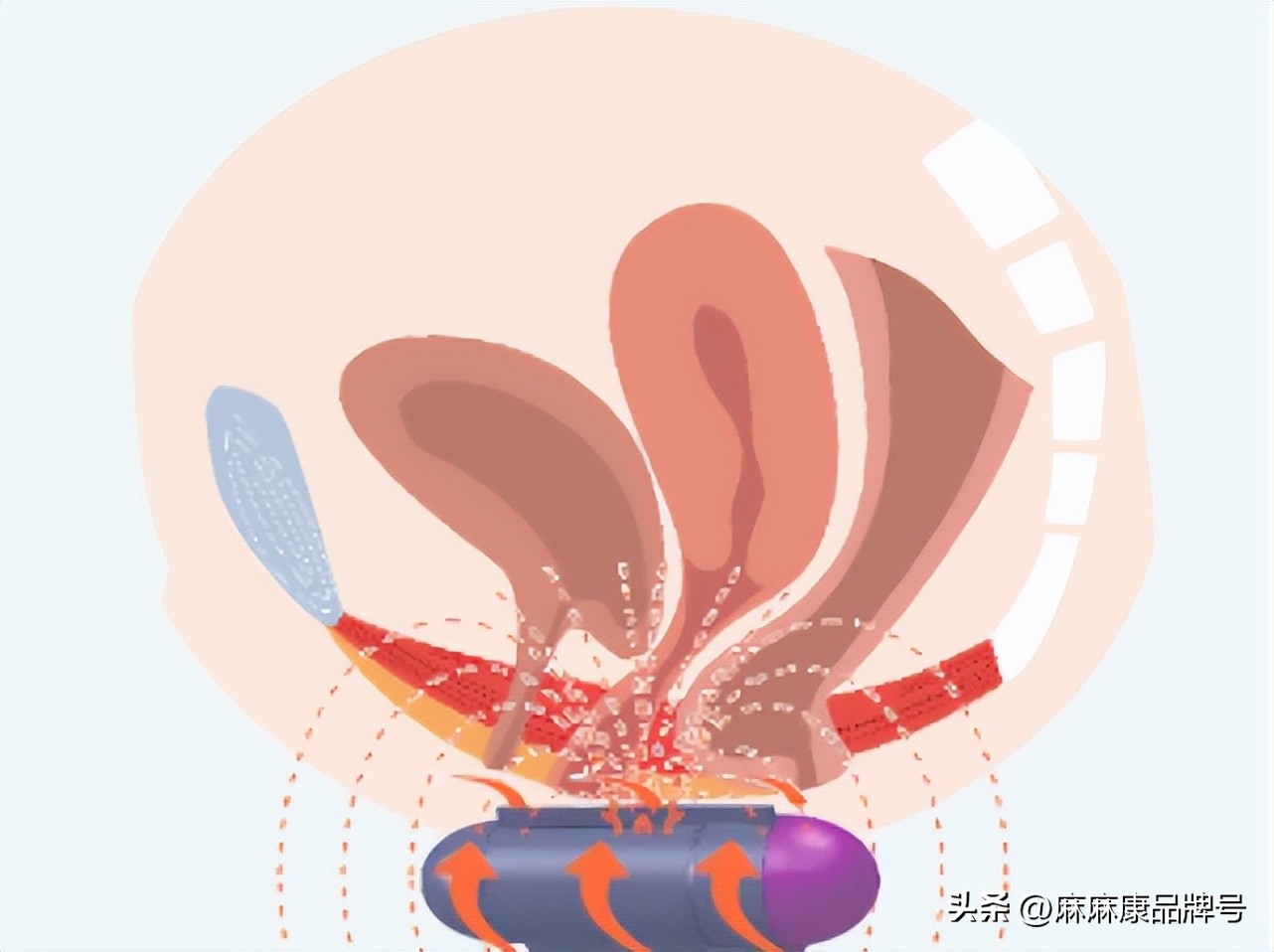 盆底肌电刺激与磁刺激的区别,什么是盆底磁刺激