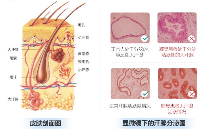 想去除狐臭可以吗,想去除异味怎么办