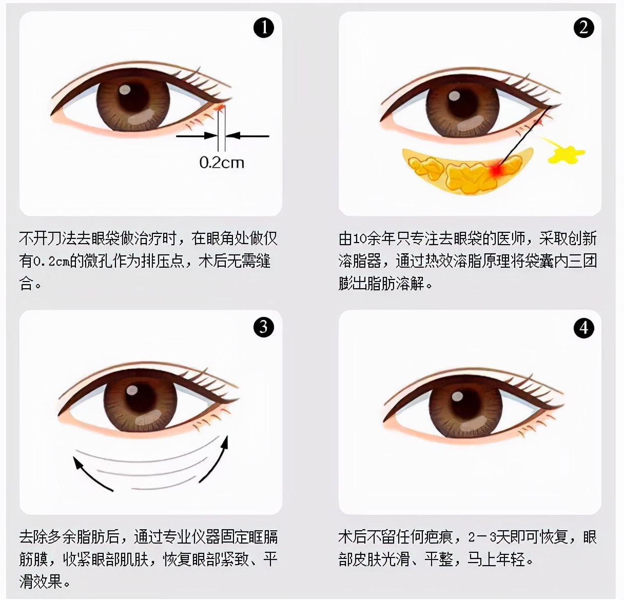 微整切眉去眼袋可以年轻多少岁,有几种快速去眼袋的方法