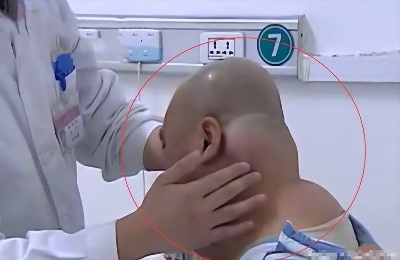 辽宁男子喝3万斤酒撑大脖子,男子嗜酒如命一天三四斤白酒