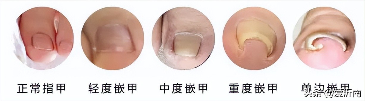 脚趾甲沟炎肿了怎么办一碰就疼,甲沟炎把指甲拔了还是肿