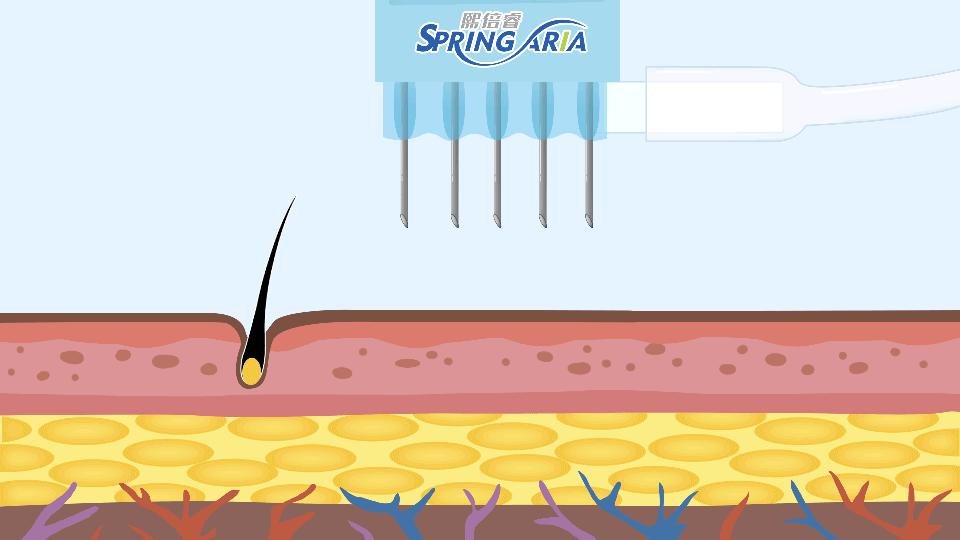 皮肤补水的水光仪,水光仪适合哪个年龄