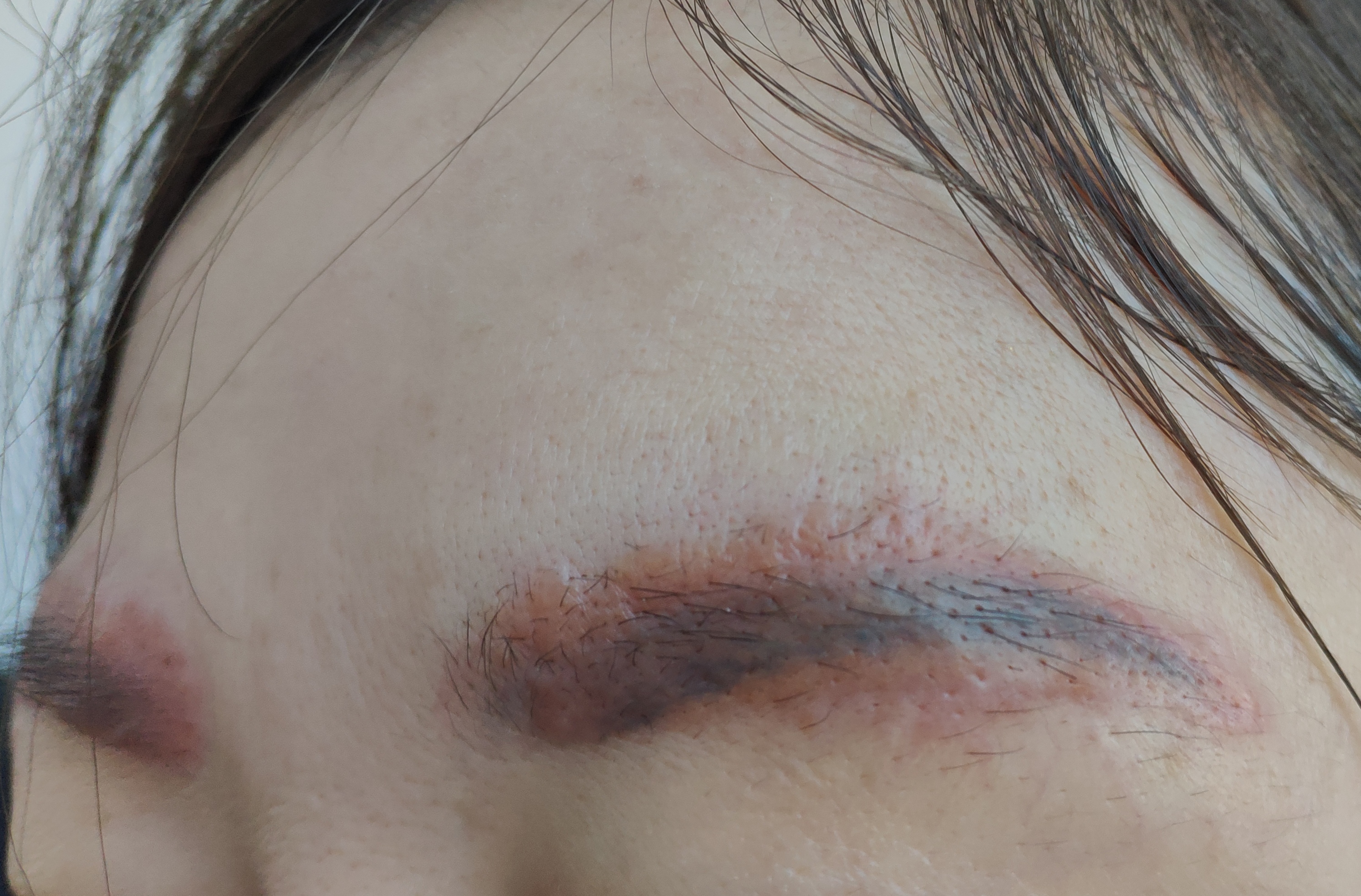 头屑多脱发怎么去除小妙招,头屑如何调理生发最有效