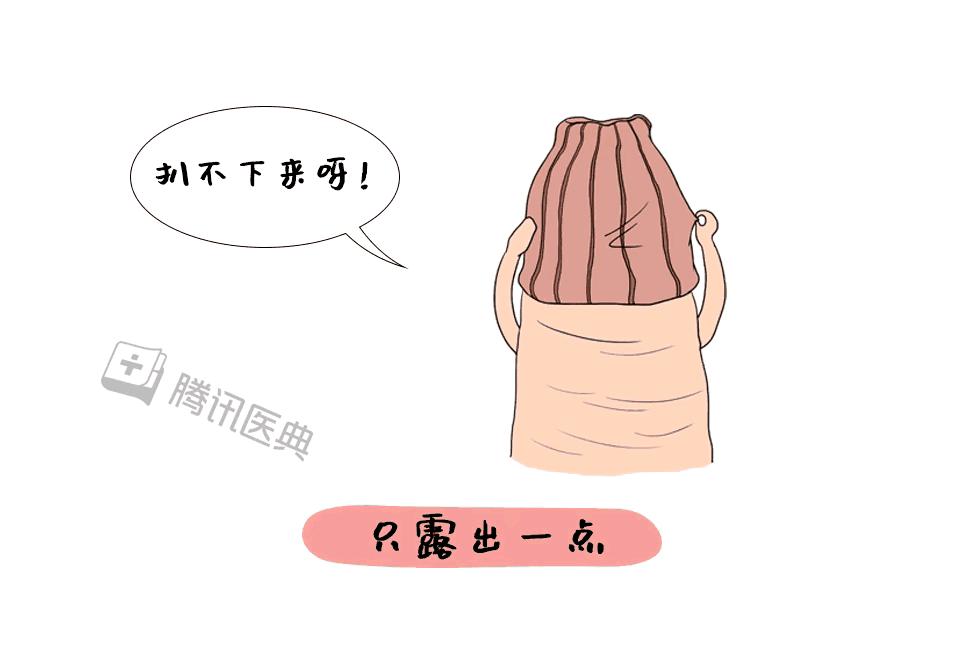 割完包皮后要恢复多久,割完包皮之后要多久恢复