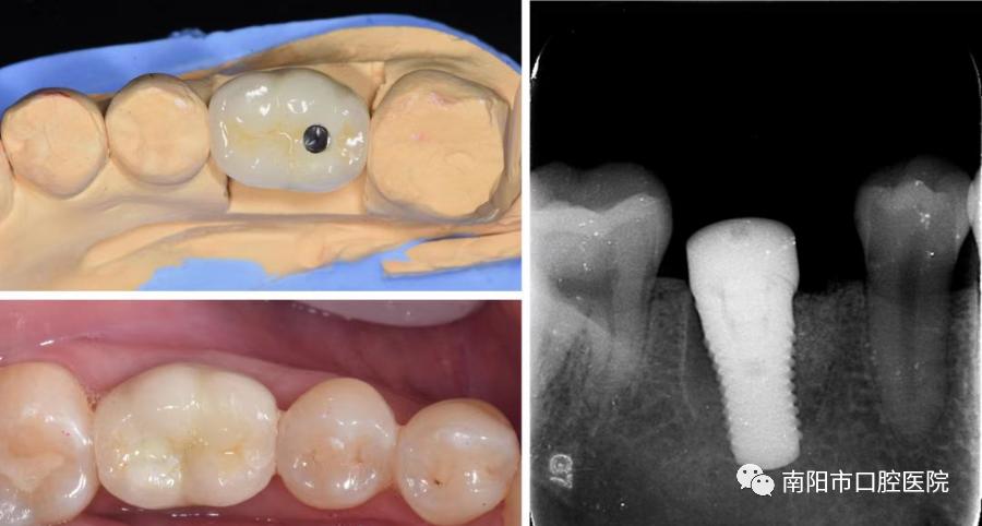 医生问你牙怎么这么不好,医生说我的牙齿裂开了怎么治疗