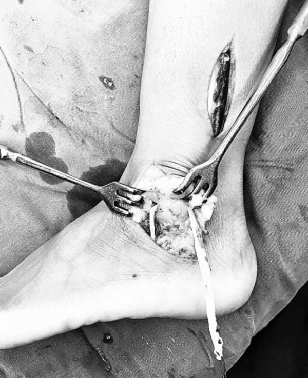 踝关节韧带损伤病历模板,踝关节外侧韧带损伤发病原因