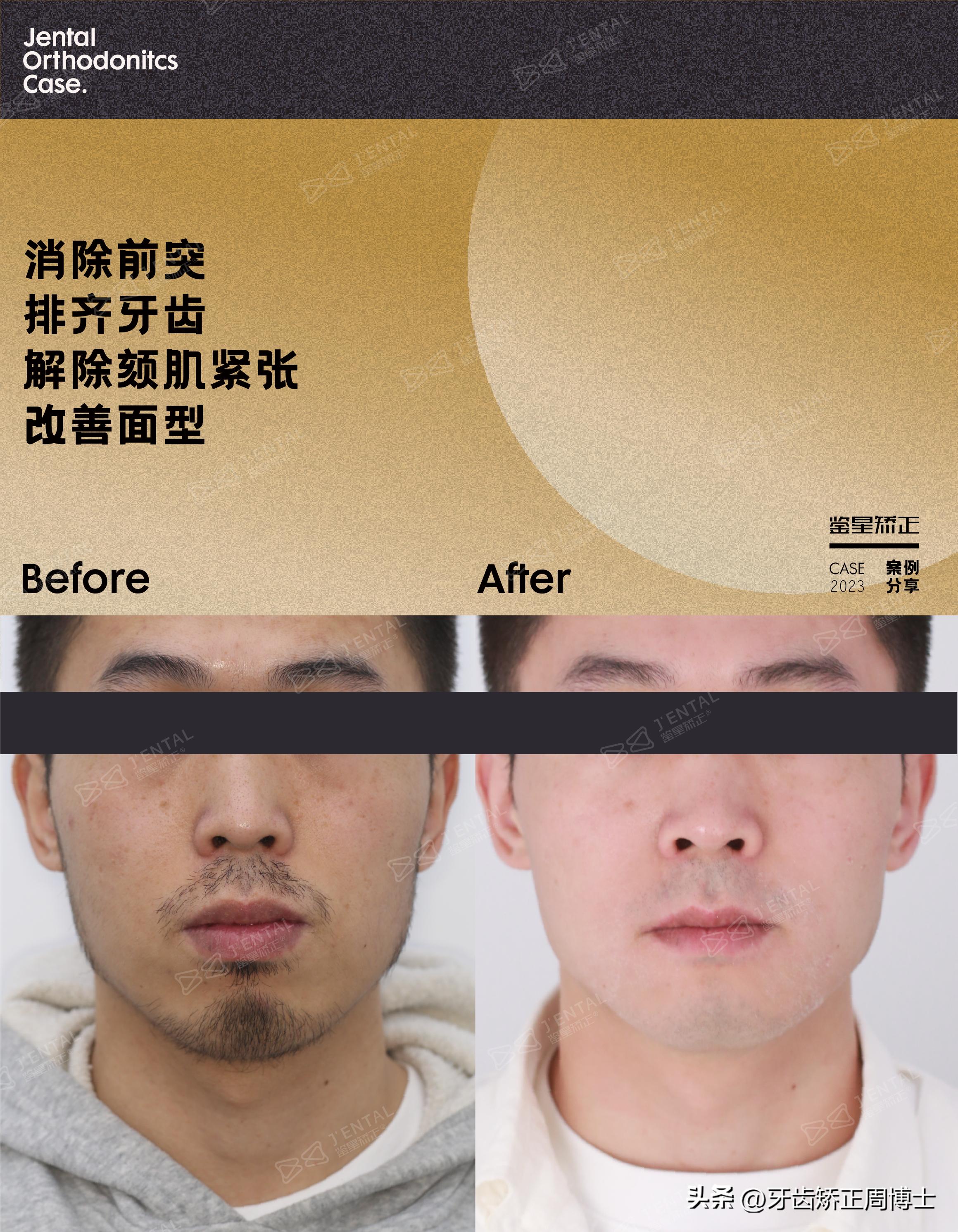 智齿正畸替代第二磨牙危害,智齿矫正代替第二磨牙3d图