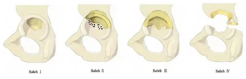 人工髋关节翻修术,人工髋关节翻修能翻修多少次