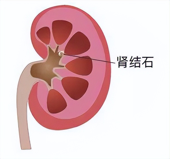 肾结石和胆结石哪个能排出石头,牙结石肾结石胆结石