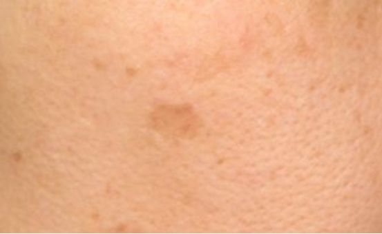 淡斑祛斑最简单的方法,都有什么方法可以淡斑