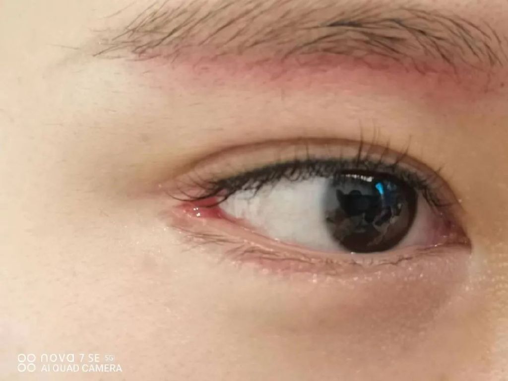 开外眼角优点和缺点,外眼角开的不明显还可以再开吗