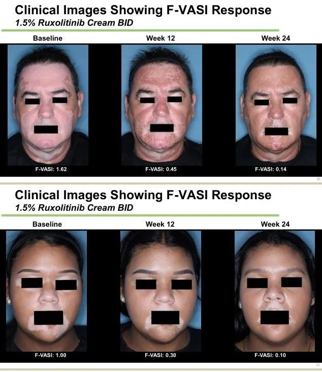 冯导白癜风治好了吗,冯导的白癜风治疗方法