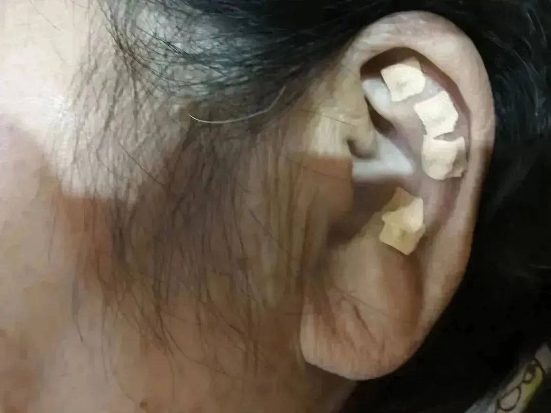 耳朵会说话|阳羡安仁坊耳穴疗法公益培训小记