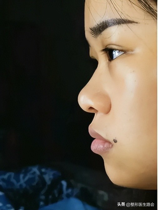 整形科普隆鼻应关注的几个问题,隆鼻为什么那么多人修复