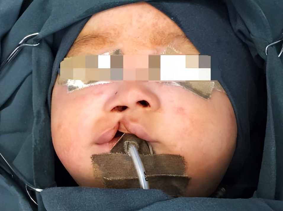 婴儿唇腭裂怎么护理,唇腭裂麻醉