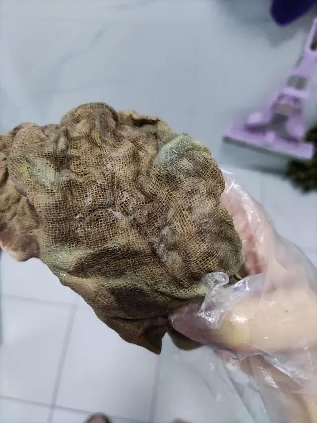 女子顺产2月后体内被留有纱布，卫健委回应助产师操作失误