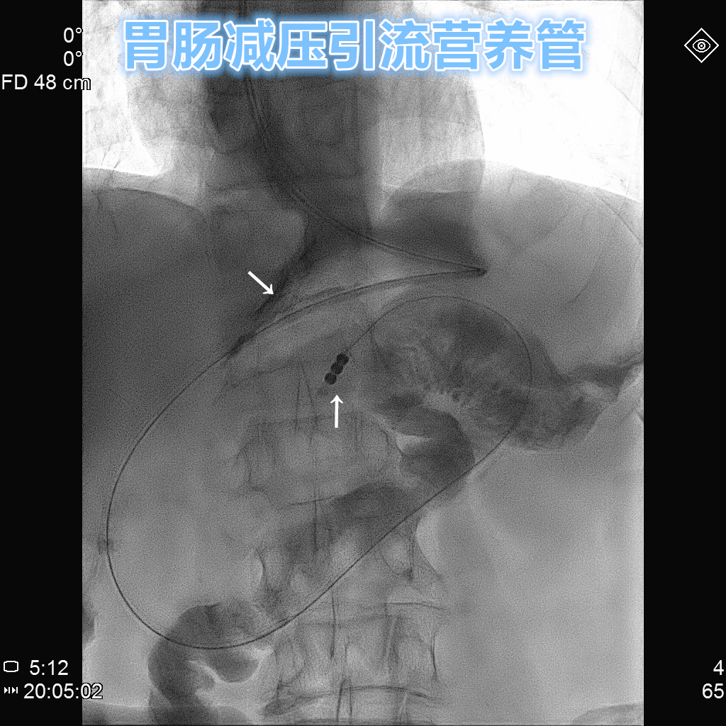 十二指肠切除手术后胃瘫能恢复吗,胃管引流治疗胃瘫