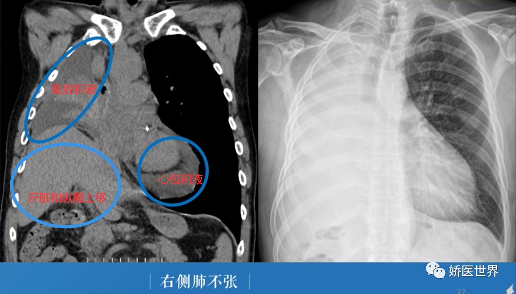 慢性阻塞性肺病肺不张,阻塞性肺不张会出现的临床症状