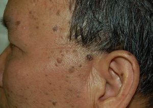 脂溢性角化老年斑会不会自动愈合,脂溢性角化老年斑用什么药膏