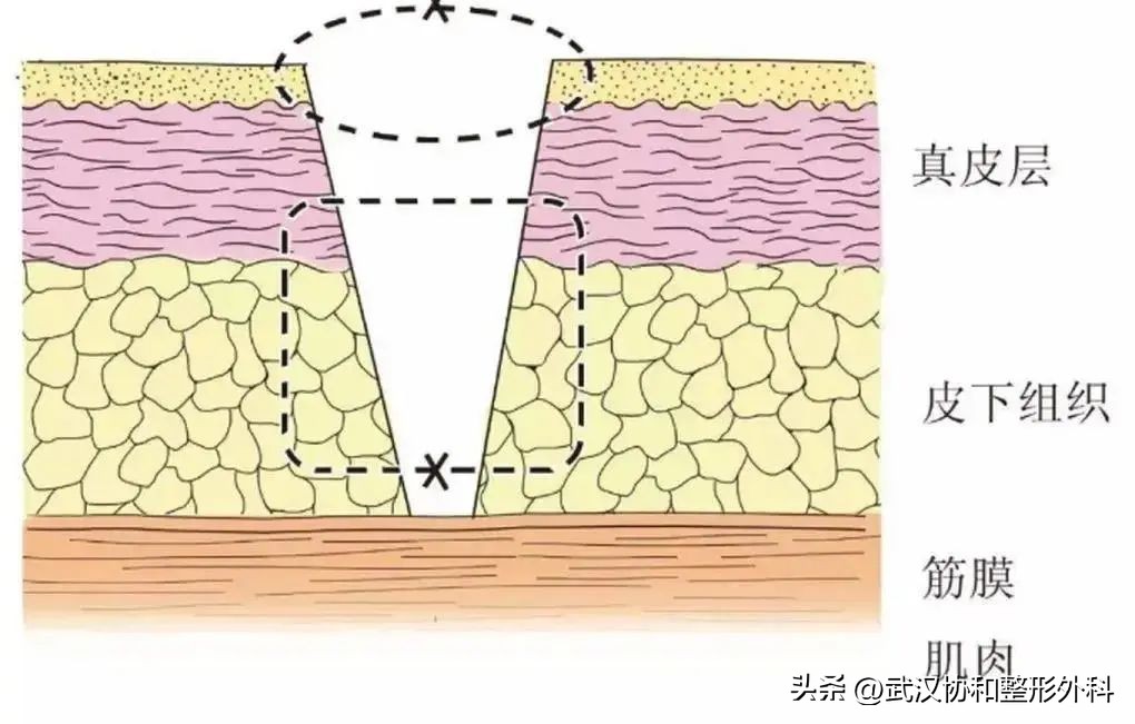可吸收缝合线会留下疤痕吗,不想留疤不建议做什么缝合