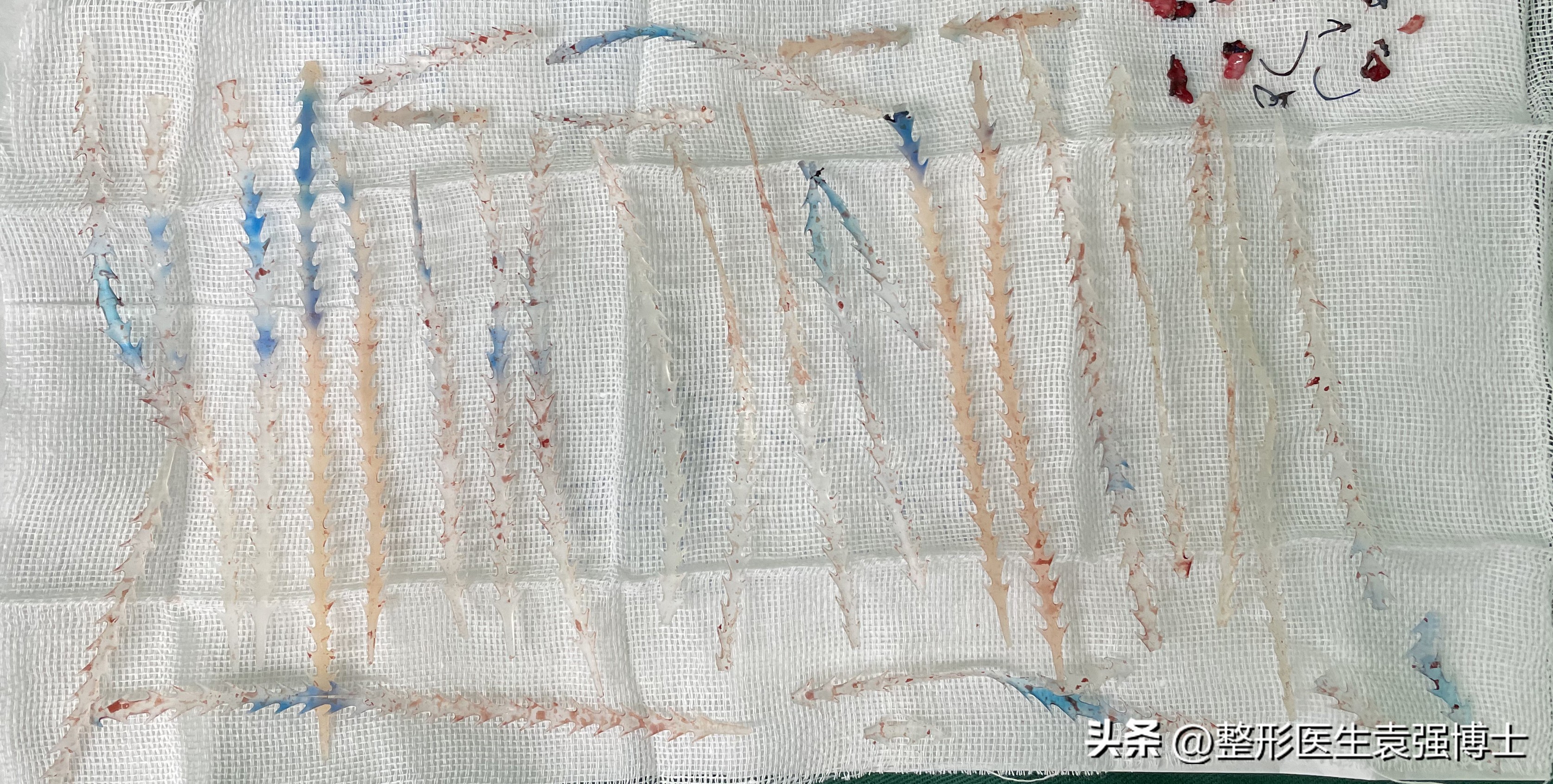 千万不要做线雕鼻后悔一辈子,不要做线雕