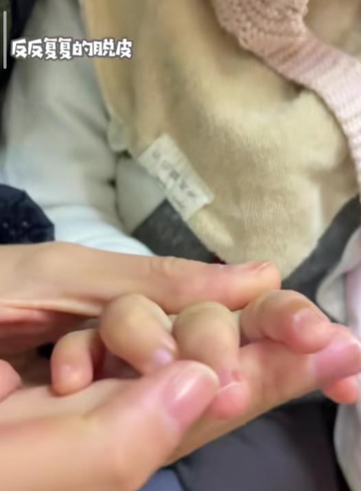 李亚鹏*女幼**手指反复脱皮，娇妻带女儿抽血检查，称与孕期地贫有关