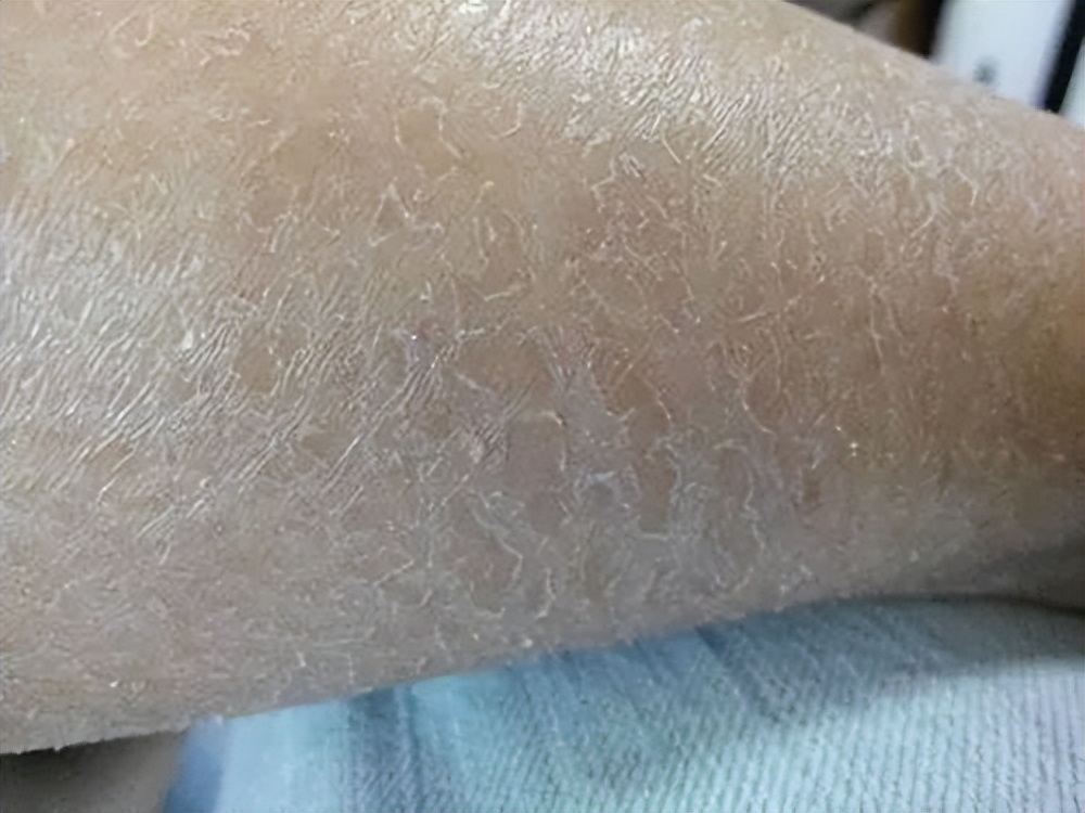 身上老是洗不干净是怎么回事,洗完澡皮肤干痒起白皮屑怎么回事