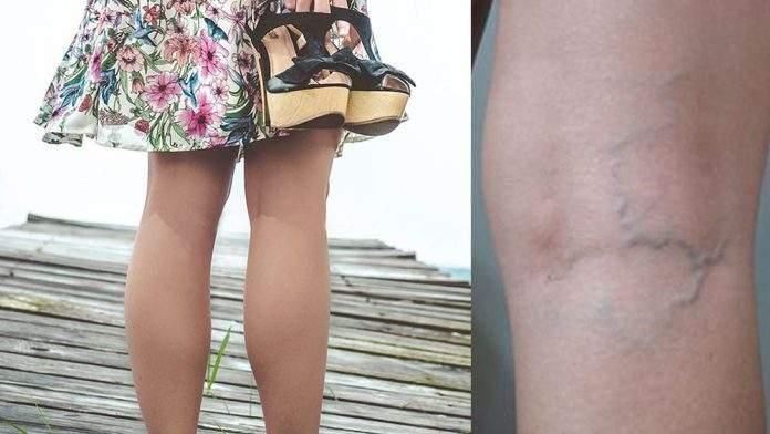 宫颈癌腿上有一个信号提示晚期,宫颈癌手术后双腿无力怎么办