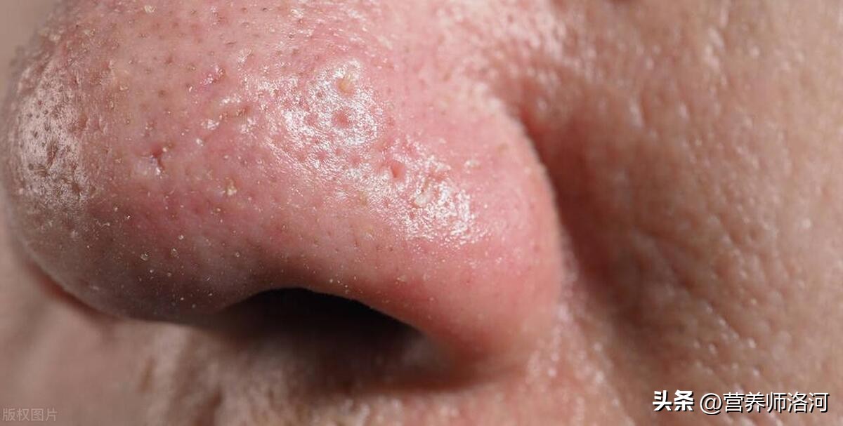 鼻头有黑头如何祛除小窍门,鼻头黑头可以喝什么来改善