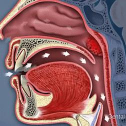 “刀片嗓”怎么快速缓解新冠,刀片喉新冠如何缓解