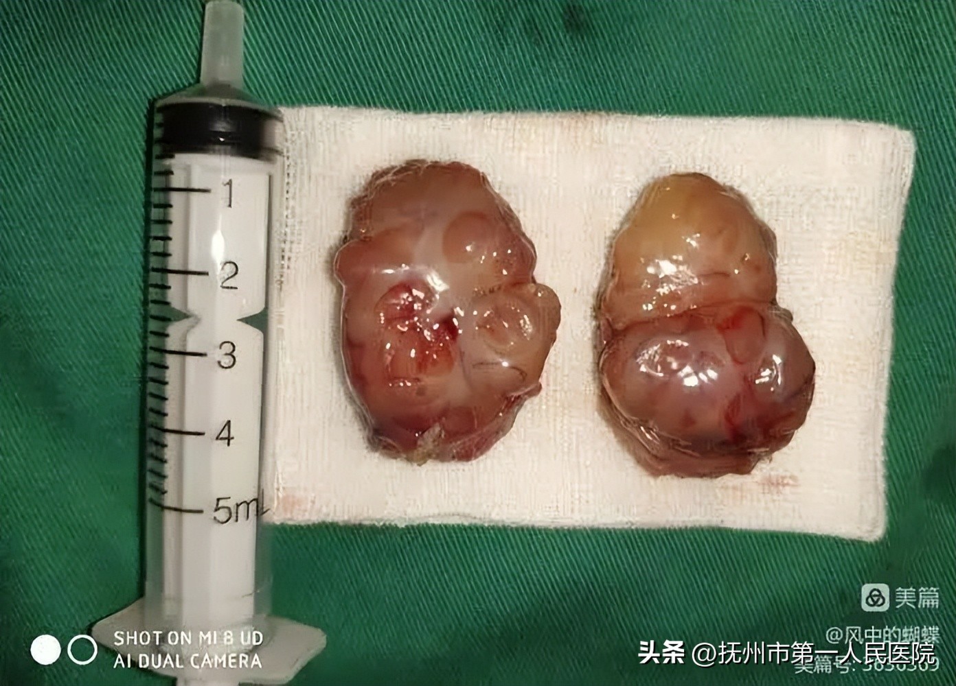 厦门耳鼻喉医院扁桃体切除,耳鼻喉科扁桃体切除术用什么方法