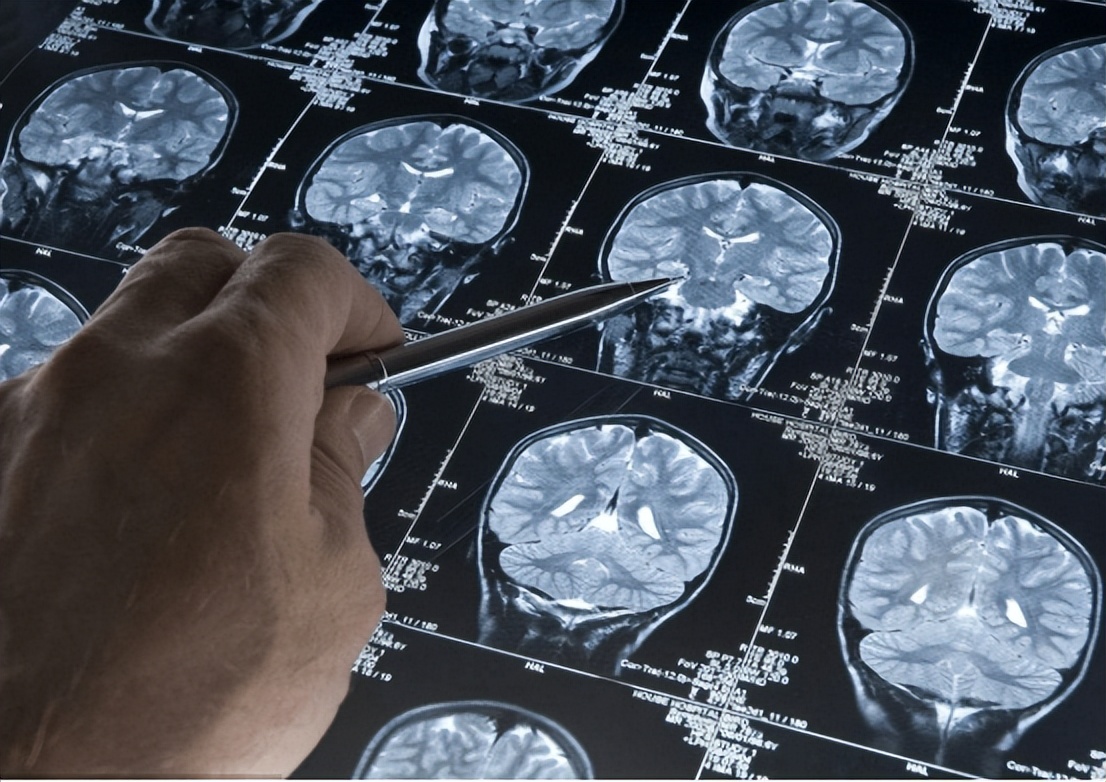 民间土方治疗脑中风,脑中风是什么原因和征兆