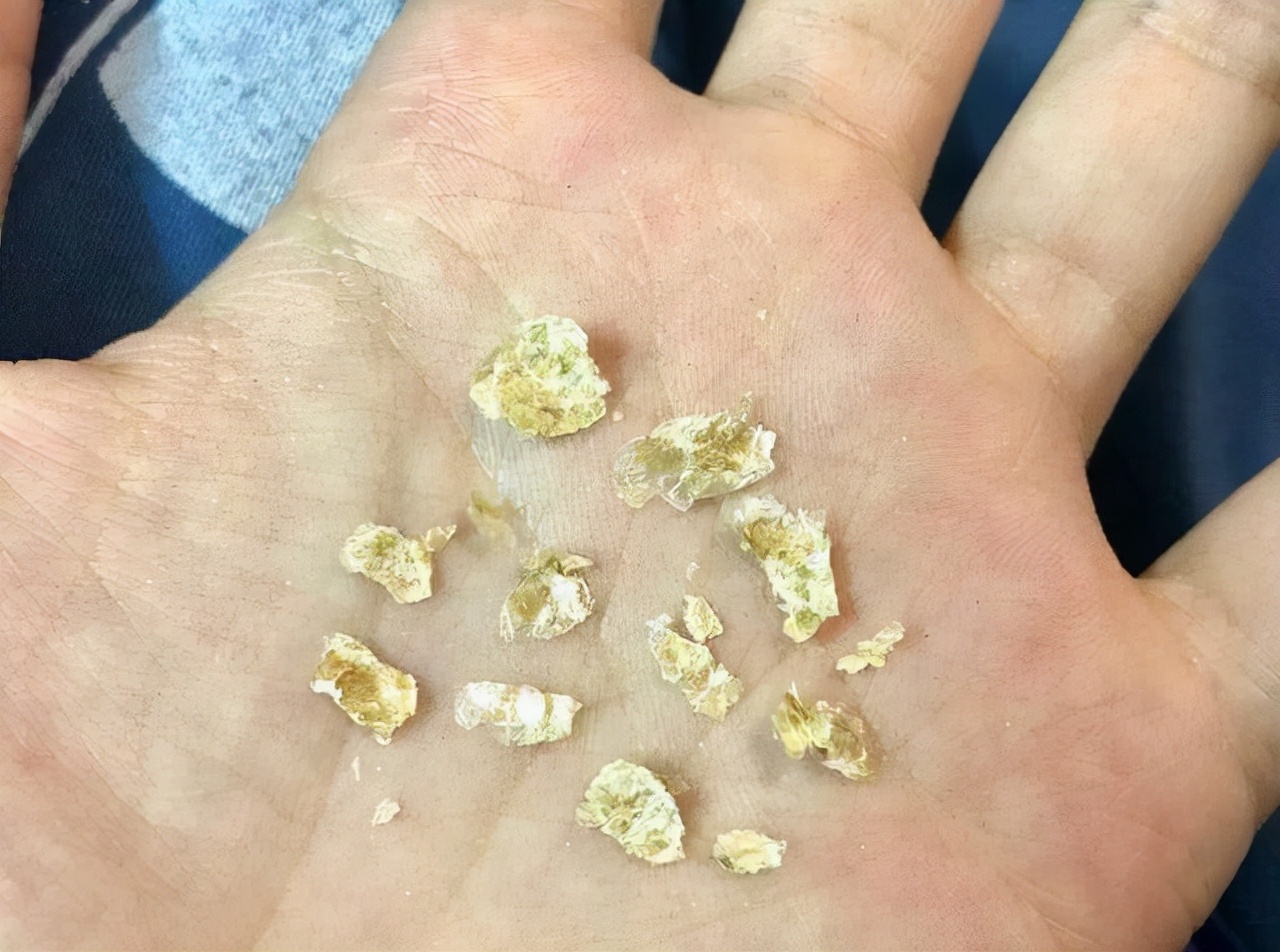 为什么有的是干耳屎有的是湿的,为什么耳屎是湿的或者干的