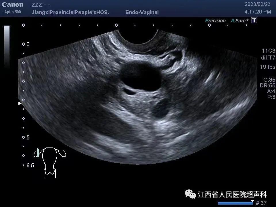 仁医科普|卵巢囊肿是什么？该如何处理？