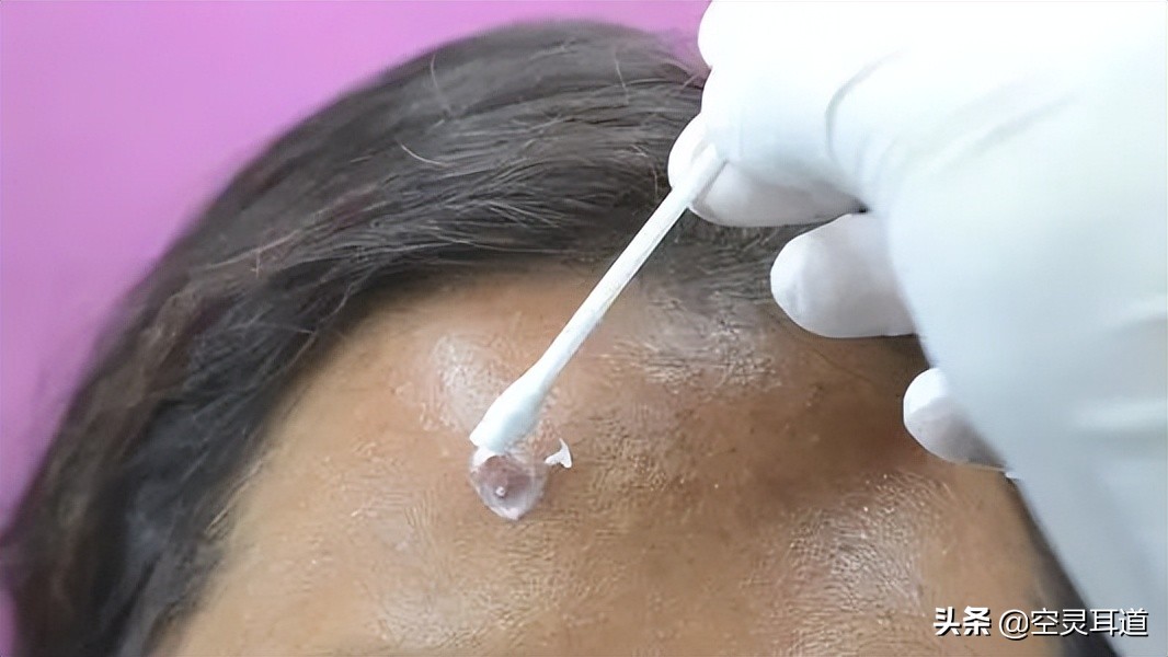 祛痘最佳攻略,祛痘治痘全过程