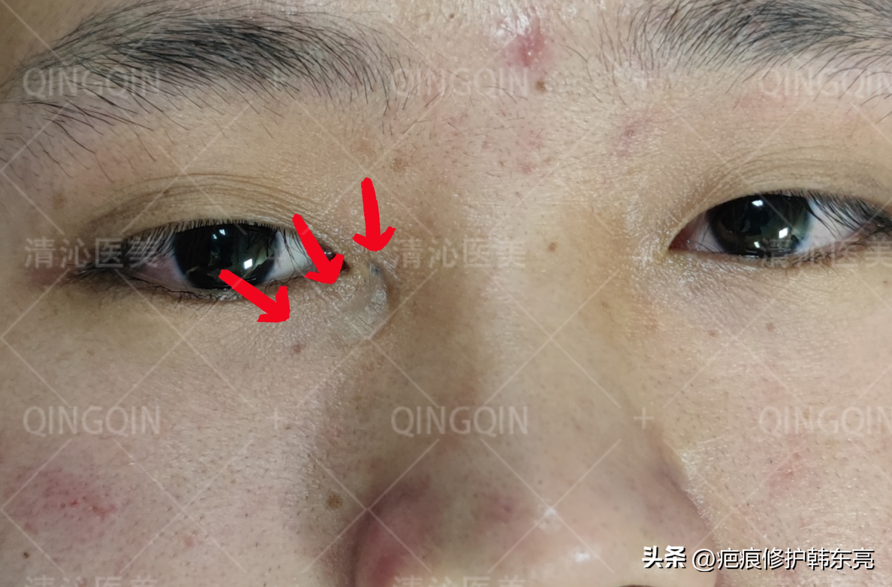 疤痕修复一次需要多少钱,上海九医院疤痕修复价目表2021