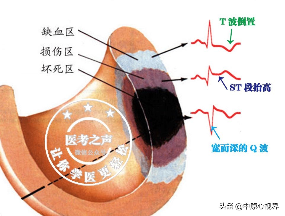 护考几种常见的心电图,常见的心电图图形分析