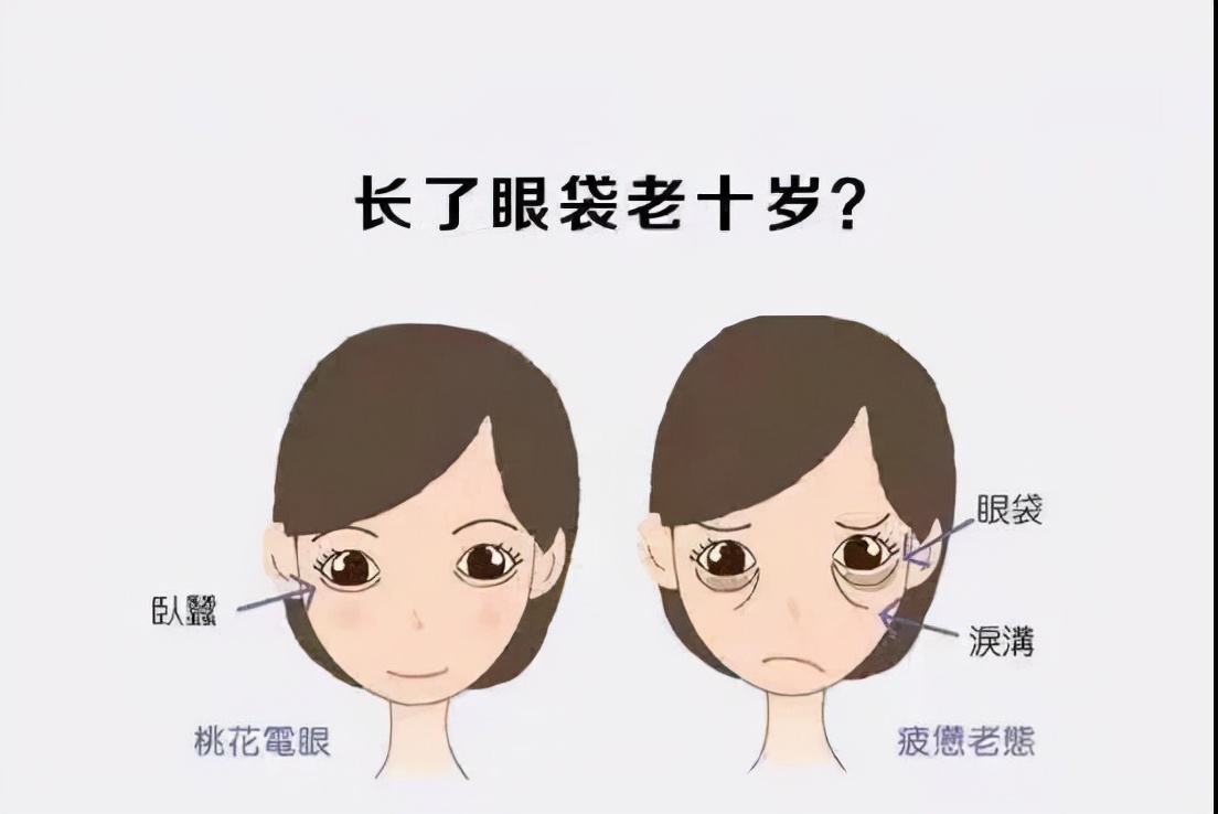 眼袋卧蚕泪沟同时具备是什么样子,卧蚕和眼袋泪沟可以一起做吗