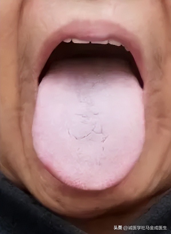 温脾补肾健脾化湿的中成药,胃肠胀气吃了药不行怎么办