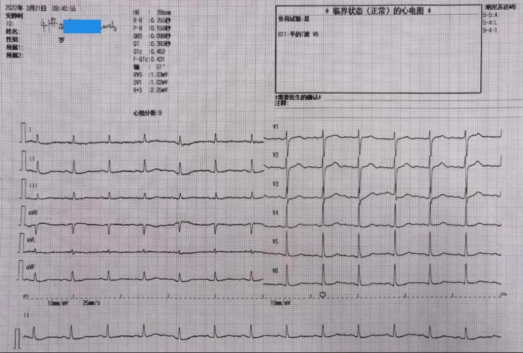 双下肢水肿心源性,心衰双下肢水肿