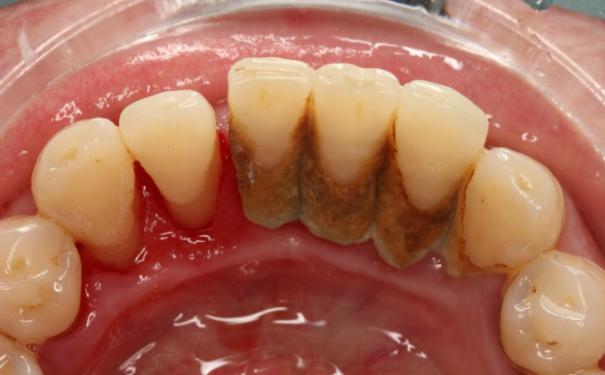 过年牙疼怎么办一招教你3秒止痛,特殊时期牙疼如何自救