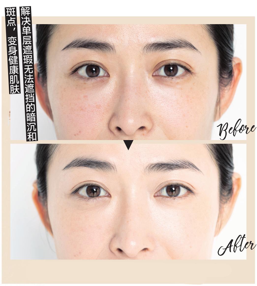 因为口罩脸上起的痘痘,因为口罩变差的皮肤解决方法