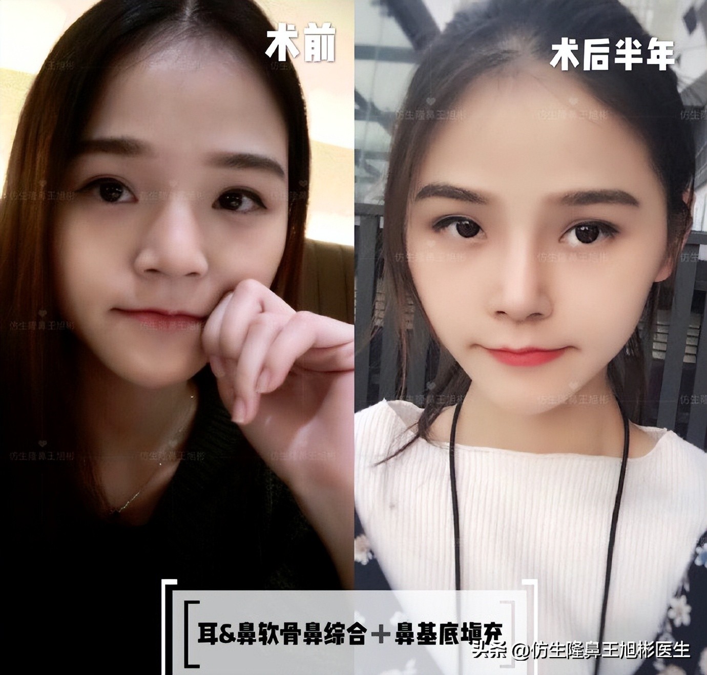 整形鼻部科普知识,隆鼻整形科普知识