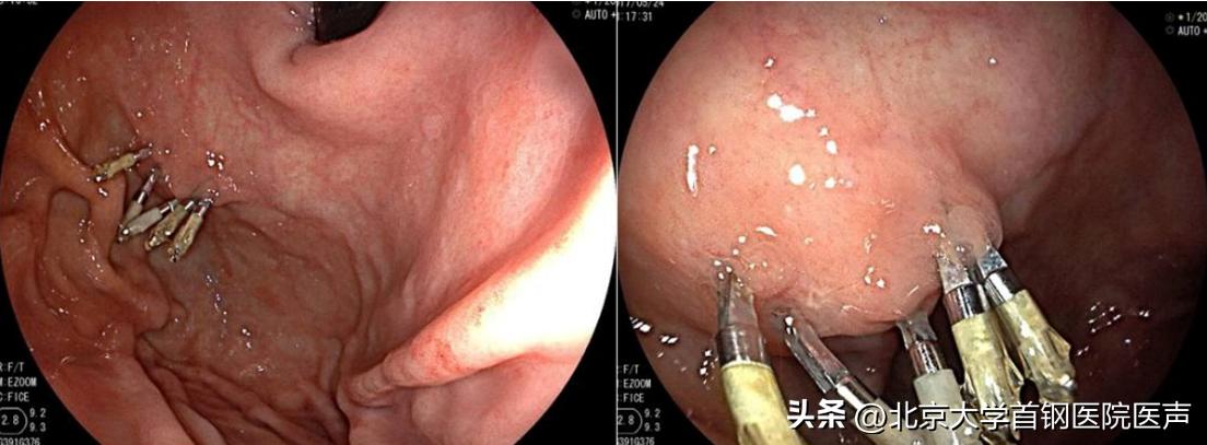 肠白塞病可以治疗好吗,肠白塞病能治愈吗