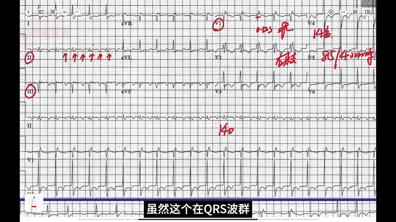 心电图病例分析-颈动脉窦受压改变房扑下传比例#执业医师考试