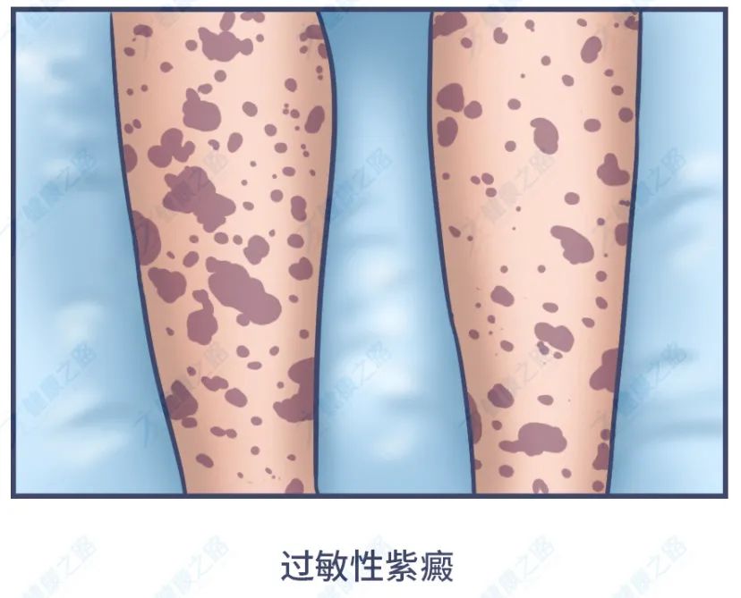 警惕身上出现的小黑痣,警惕皮肤黑痣