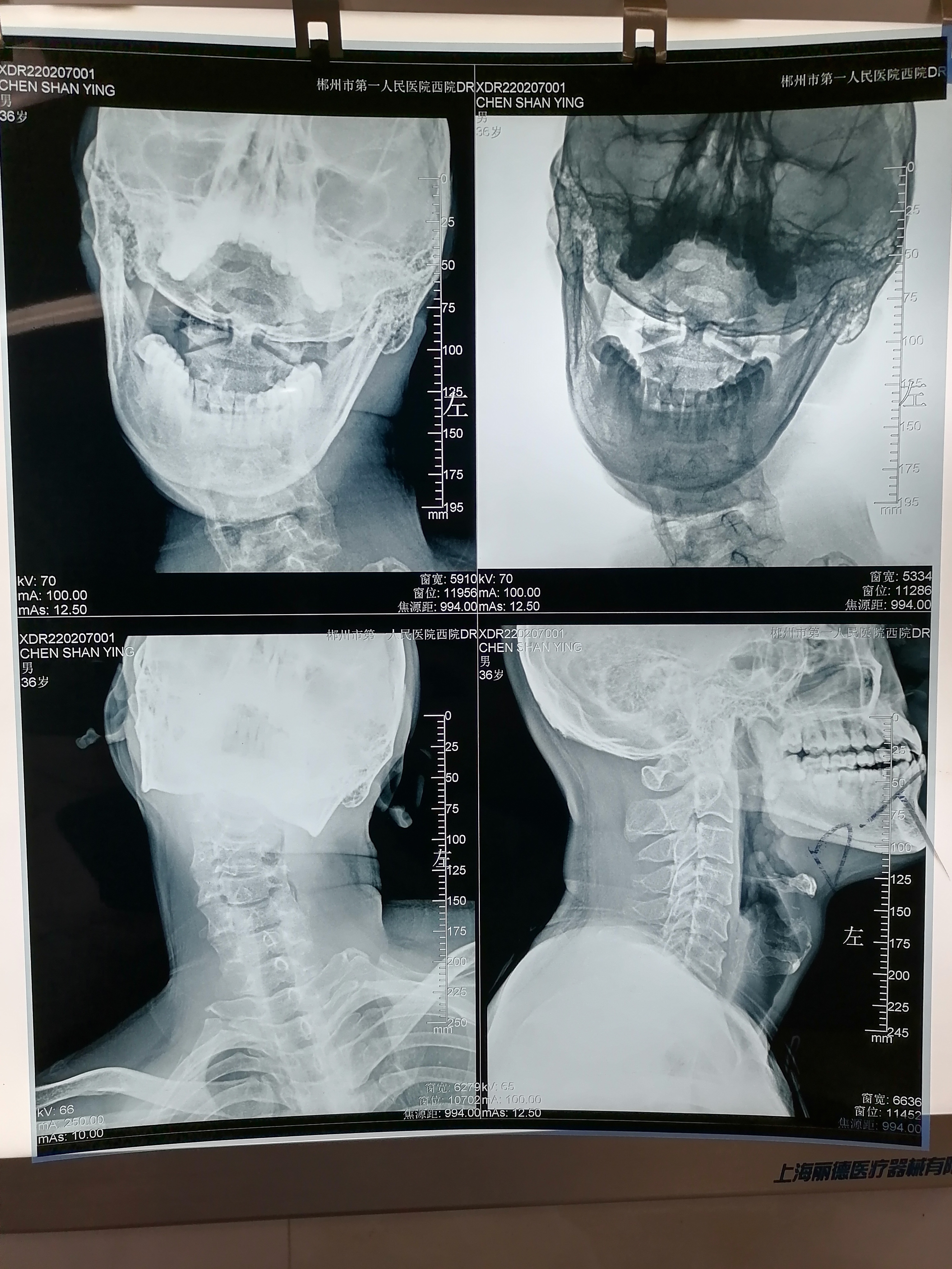 扭脖子的危害有多可怕,随便扭脖子危不危险