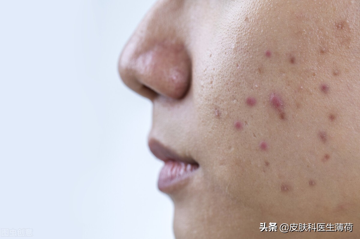 肌漾3.0修印精华淡化痘印,脸上疤痕印怎么消除淡化痘印